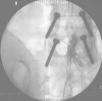 Caudal Epiduroplasty